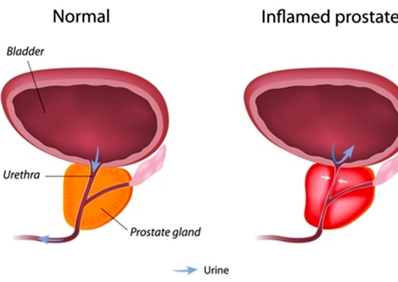 Prostatite vero dramma per i giovani adulti